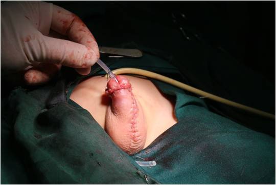 小明医生组精典病例之四:尿道下裂术后尿瘘,尿道狭窄和憩室 