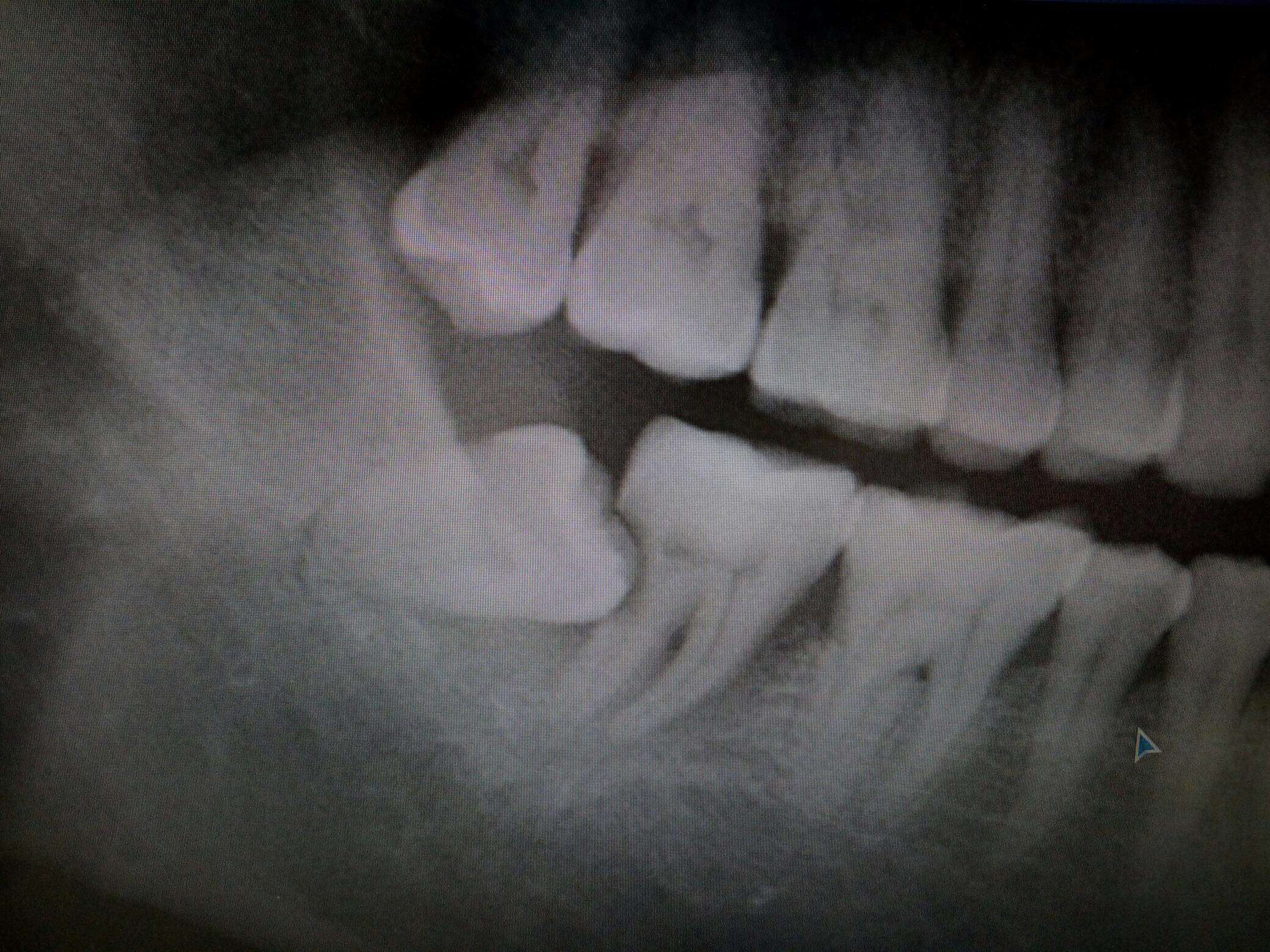 被智齿顶坏的牙齿图片图片