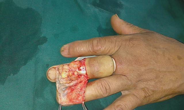 手指滑囊炎的症状图片图片