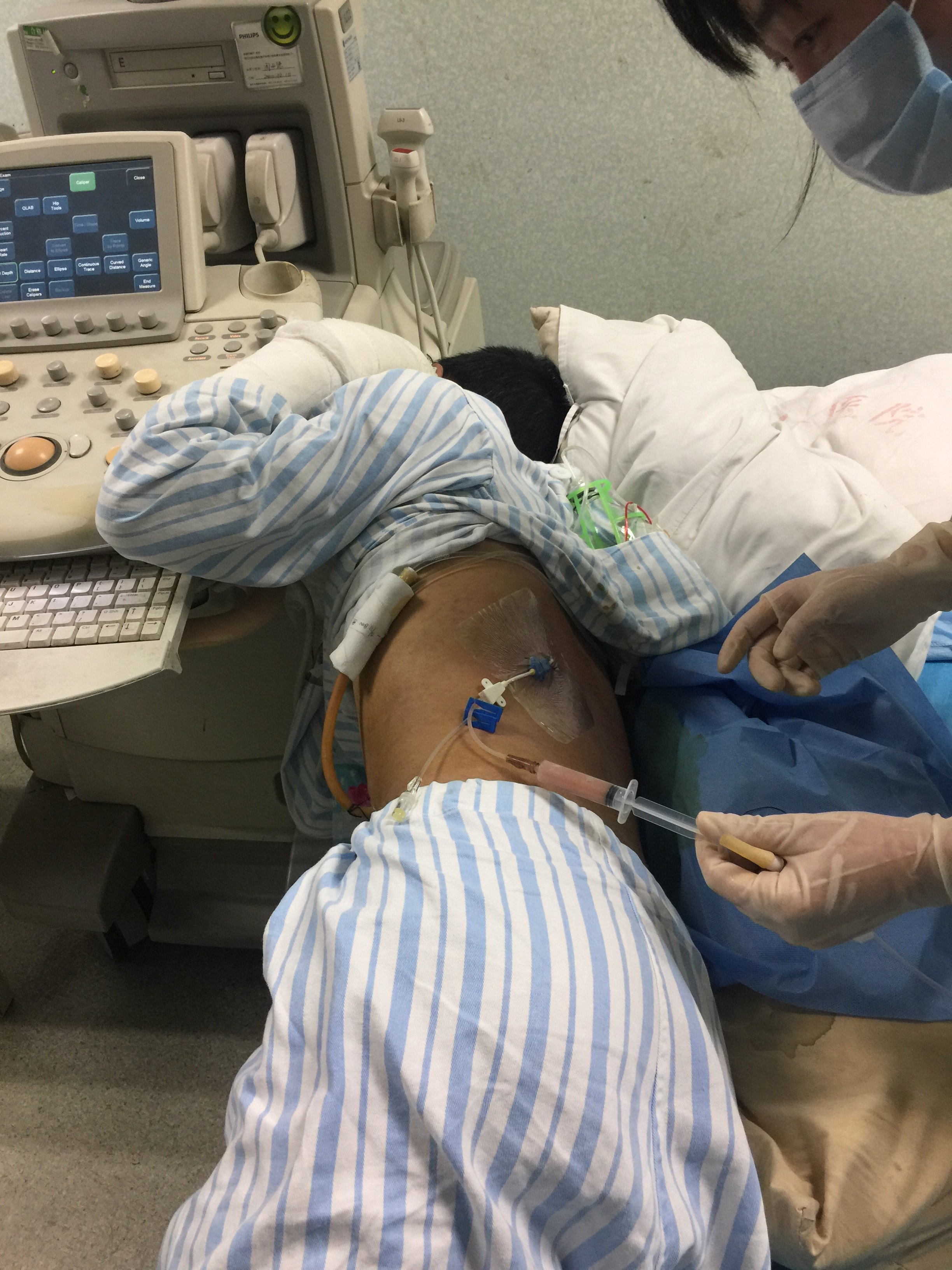胰腺断裂后囊肿后背穿刺引流控制胰漏感染 - 好大夫在线