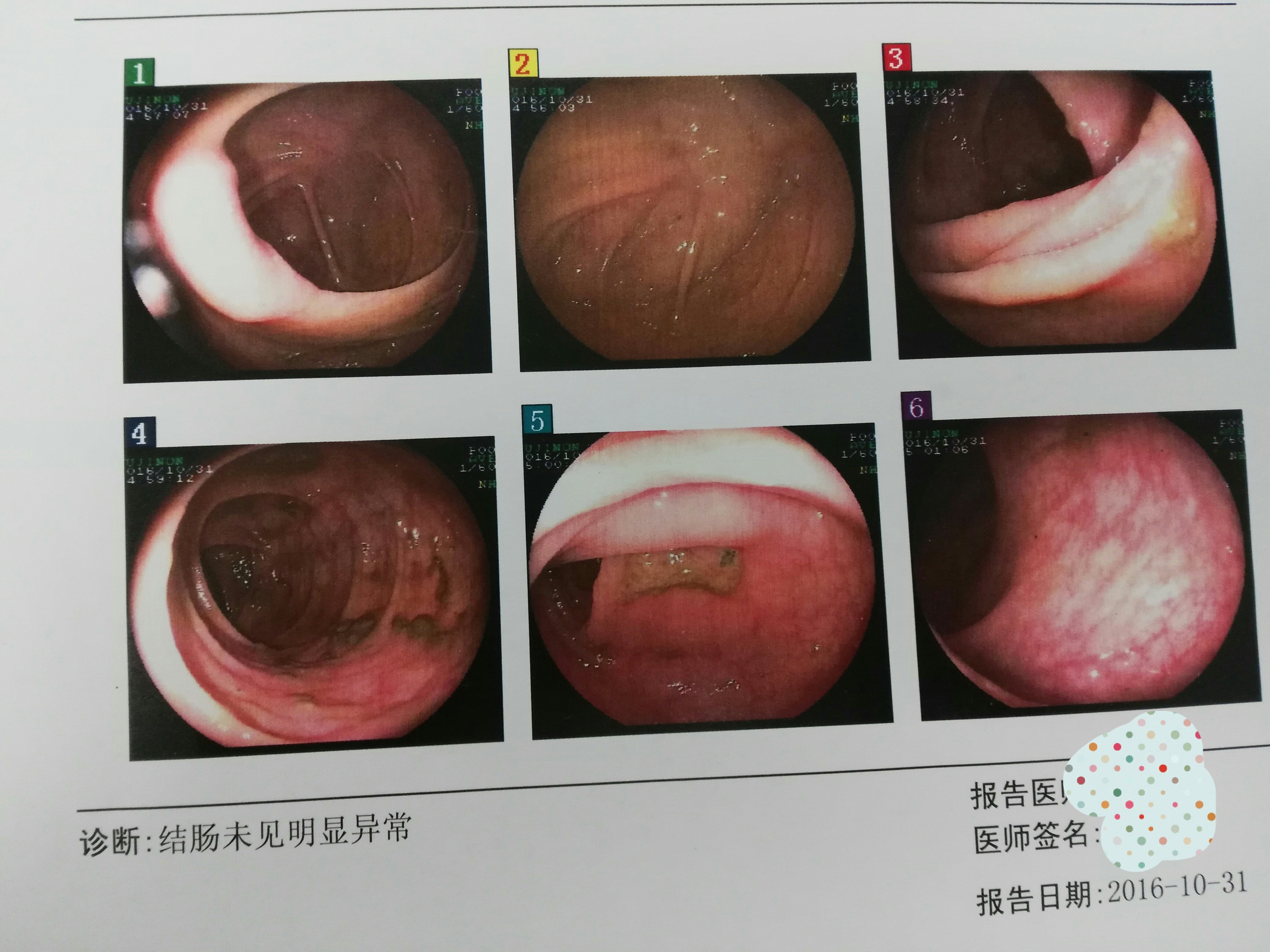 2012年,李女士的肠镜图片是这样的