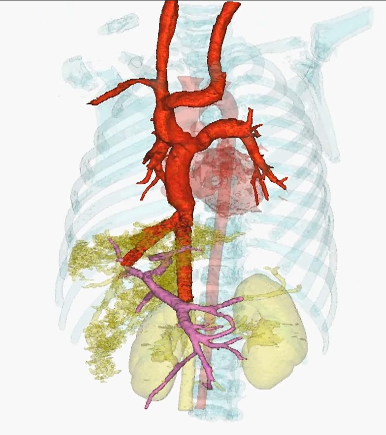 复杂先天性心脏病功能性单心室也可以用微创手