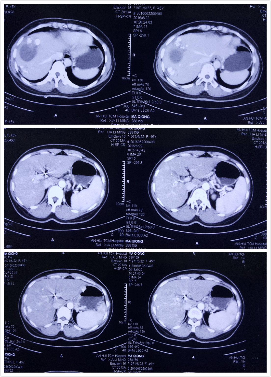 门静脉癌栓ct图片图片