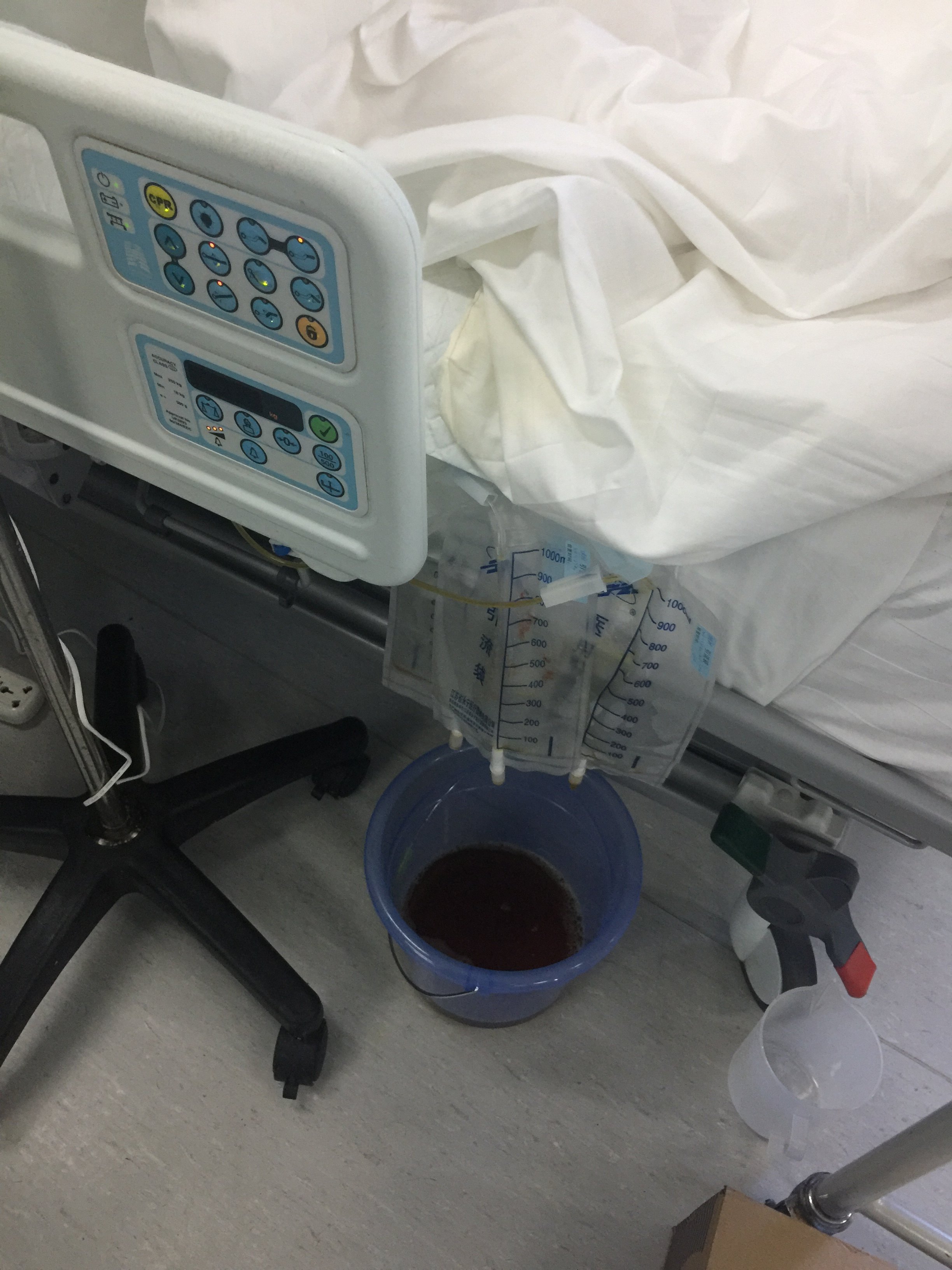 12指肠漏紧急放置胃管空肠营养管及腹腔引流管持续冲洗 - 好大夫在线