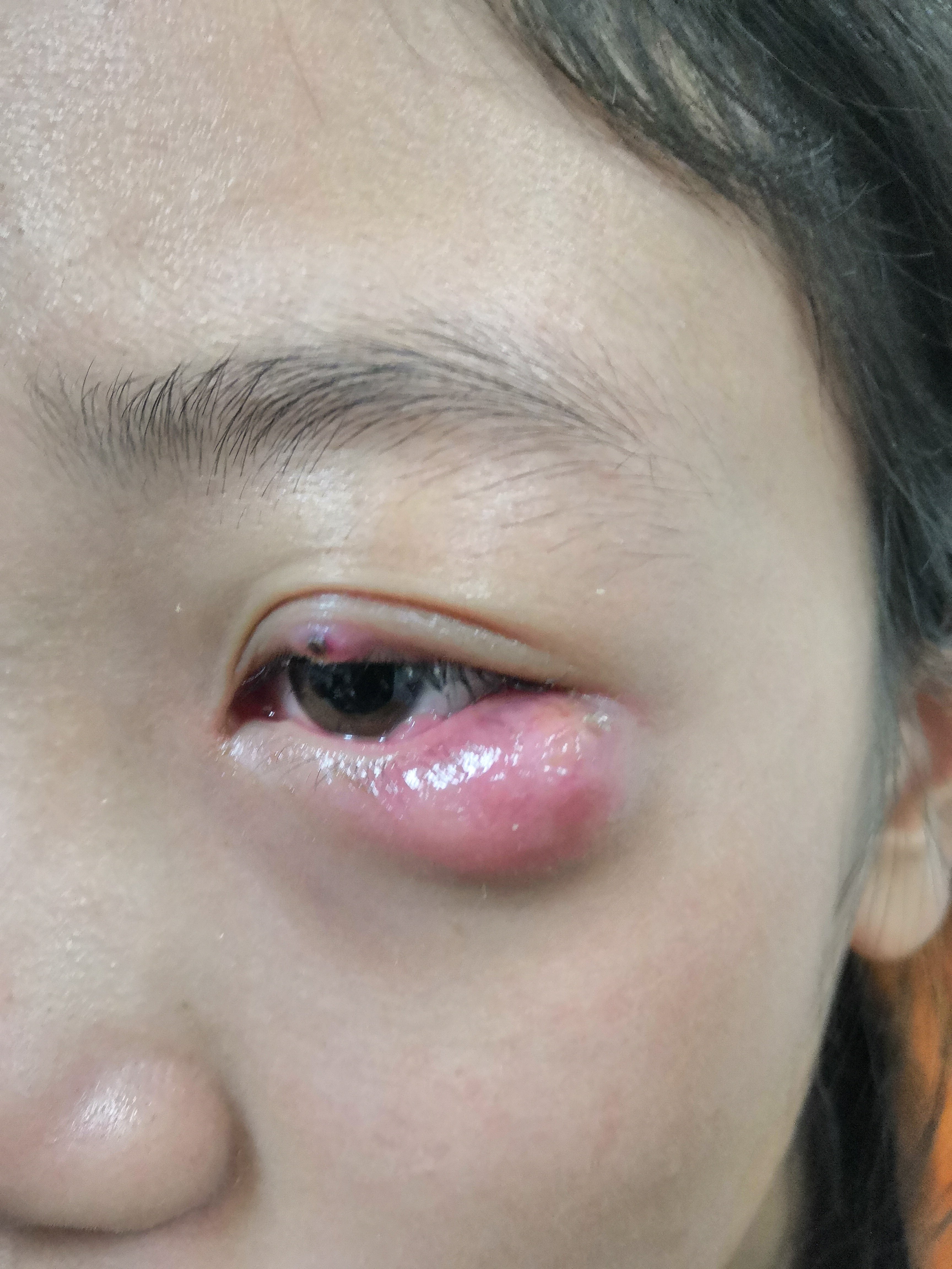 睑腺炎(俗称:麦粒肿,中医名:针眼)的个人经验治疗_麦粒肿_发病原因_治