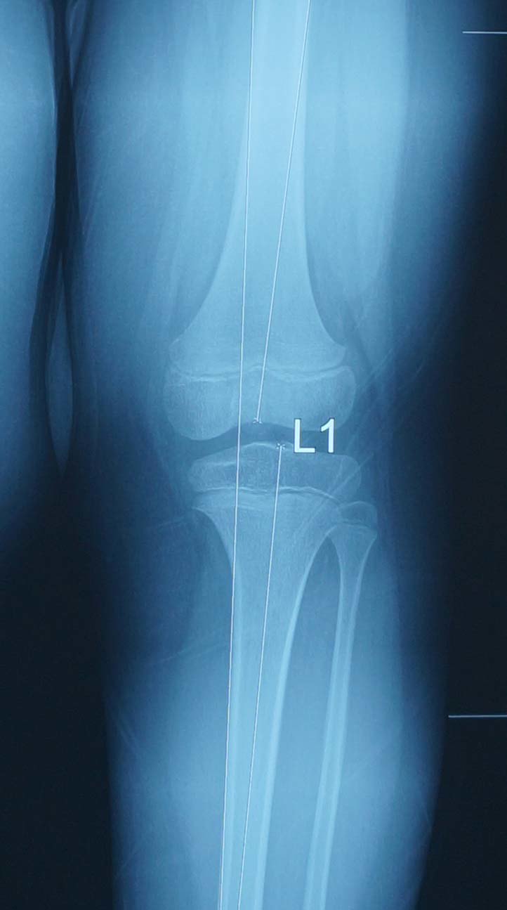 膝关节骨骺线图片图片
