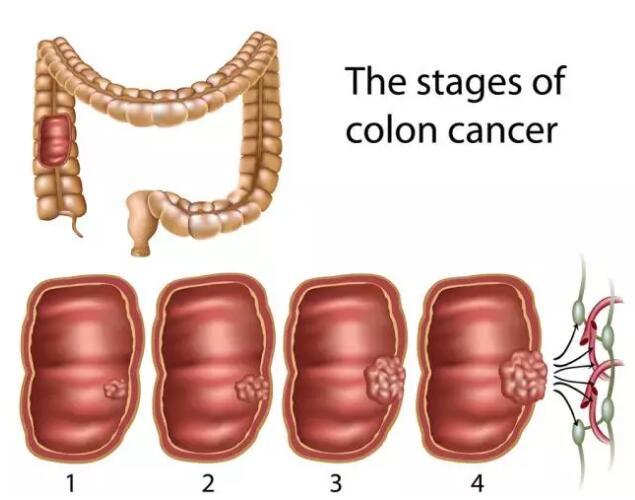 林奇综合症简介