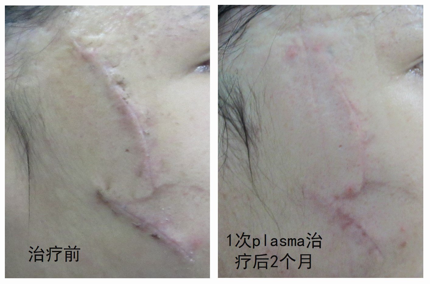 陈博士说瘢痕:细说瘢痕治疗的"来龙去脉"