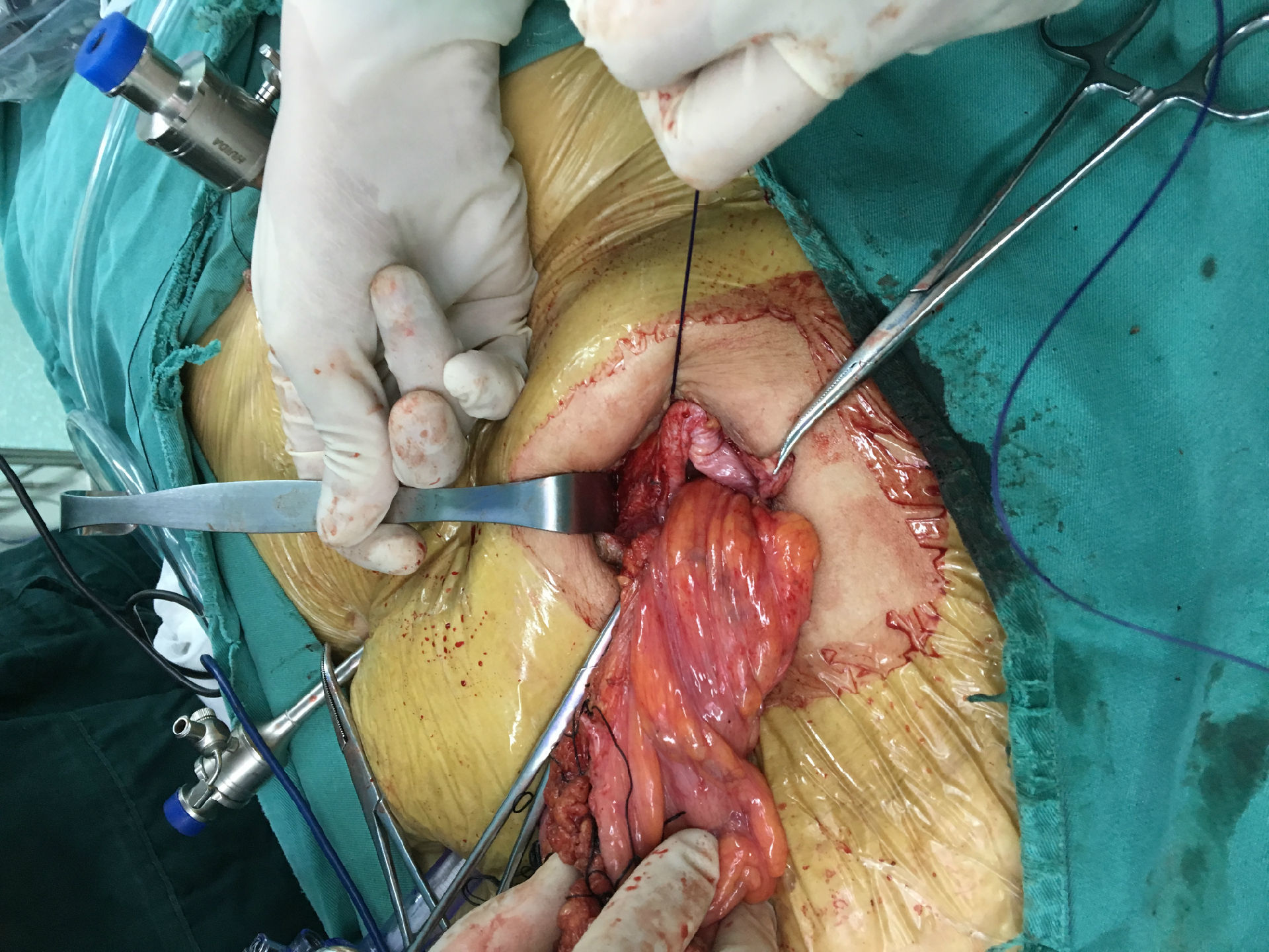 造口疝 lap-re-do 我的手术图片欣赏