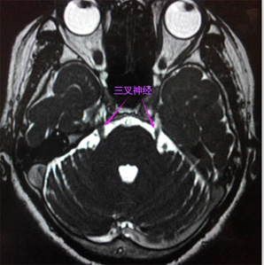 三叉神经(痛)、面神经面肌痉挛血管磁共振成像