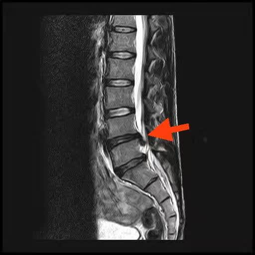 一例简式技术椎间孔镜下腰椎间盘突出髓核摘除核磁影像 