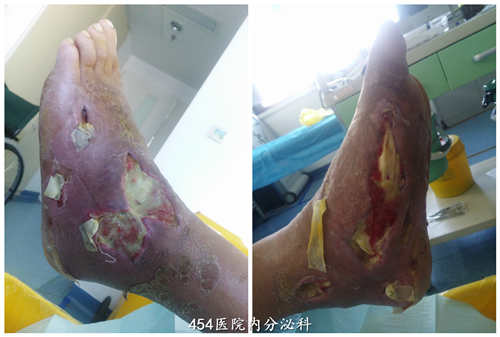 糖尿病足左足红肿破溃愈合(2016)