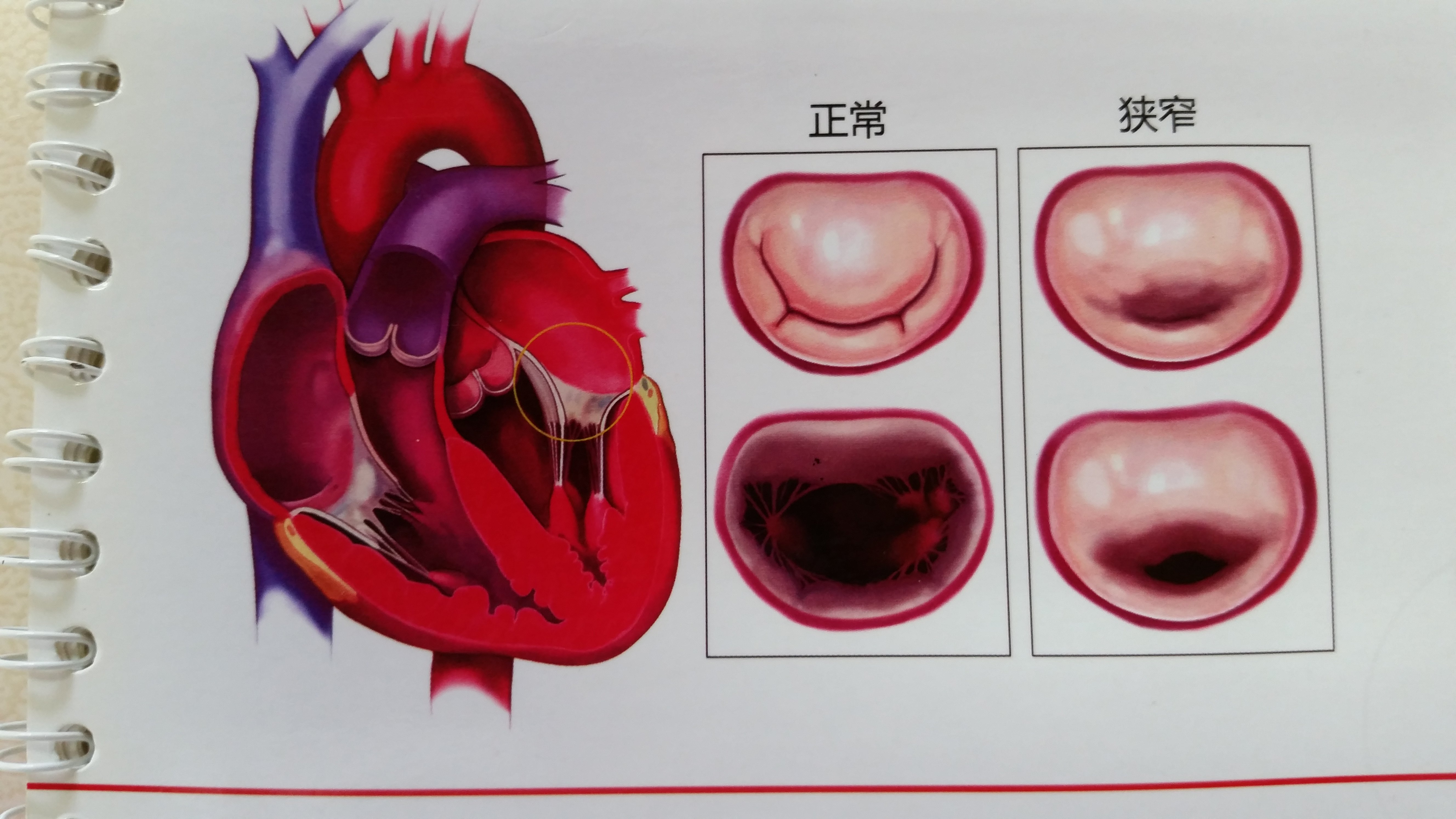 风湿性心脏病 二尖瓣狭窄