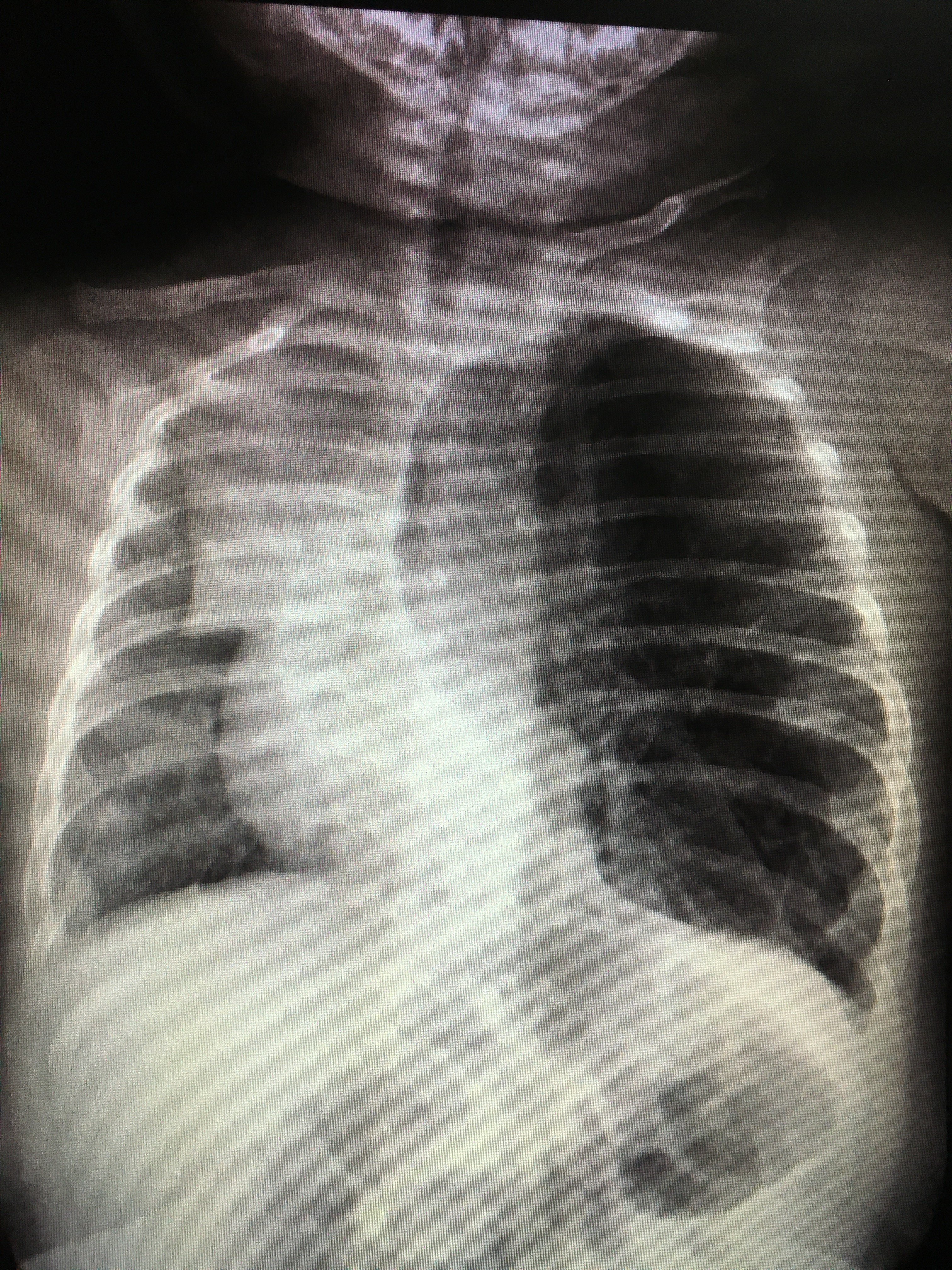 肺大泡影像图片