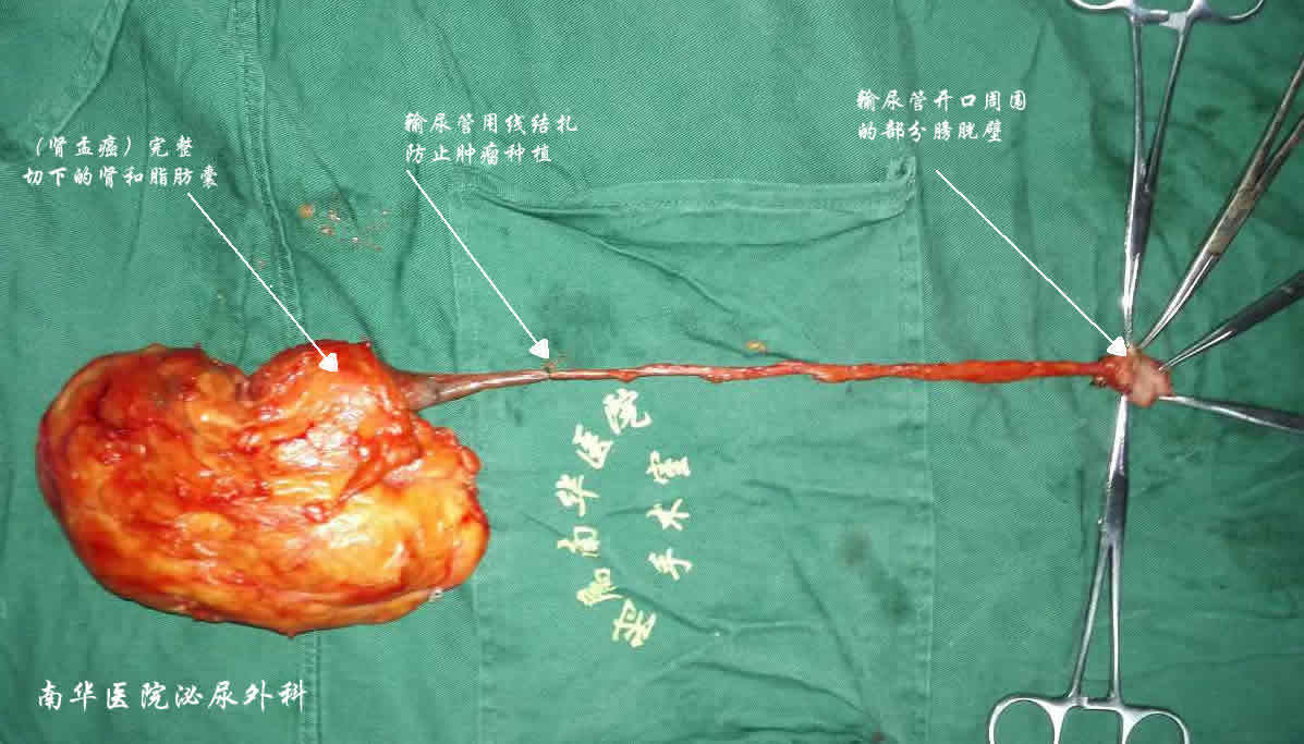 腎盂癌的治療經驗