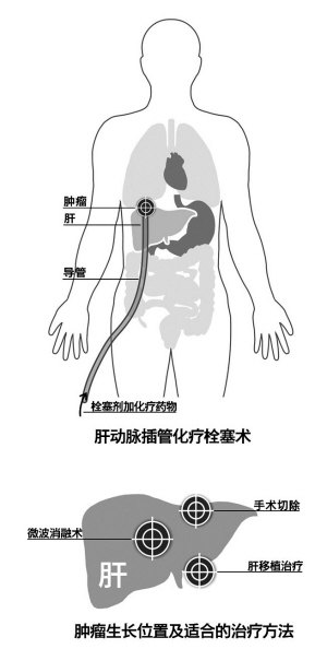 浙一肝膽胰外科中心微創20年手術量位居全國前列