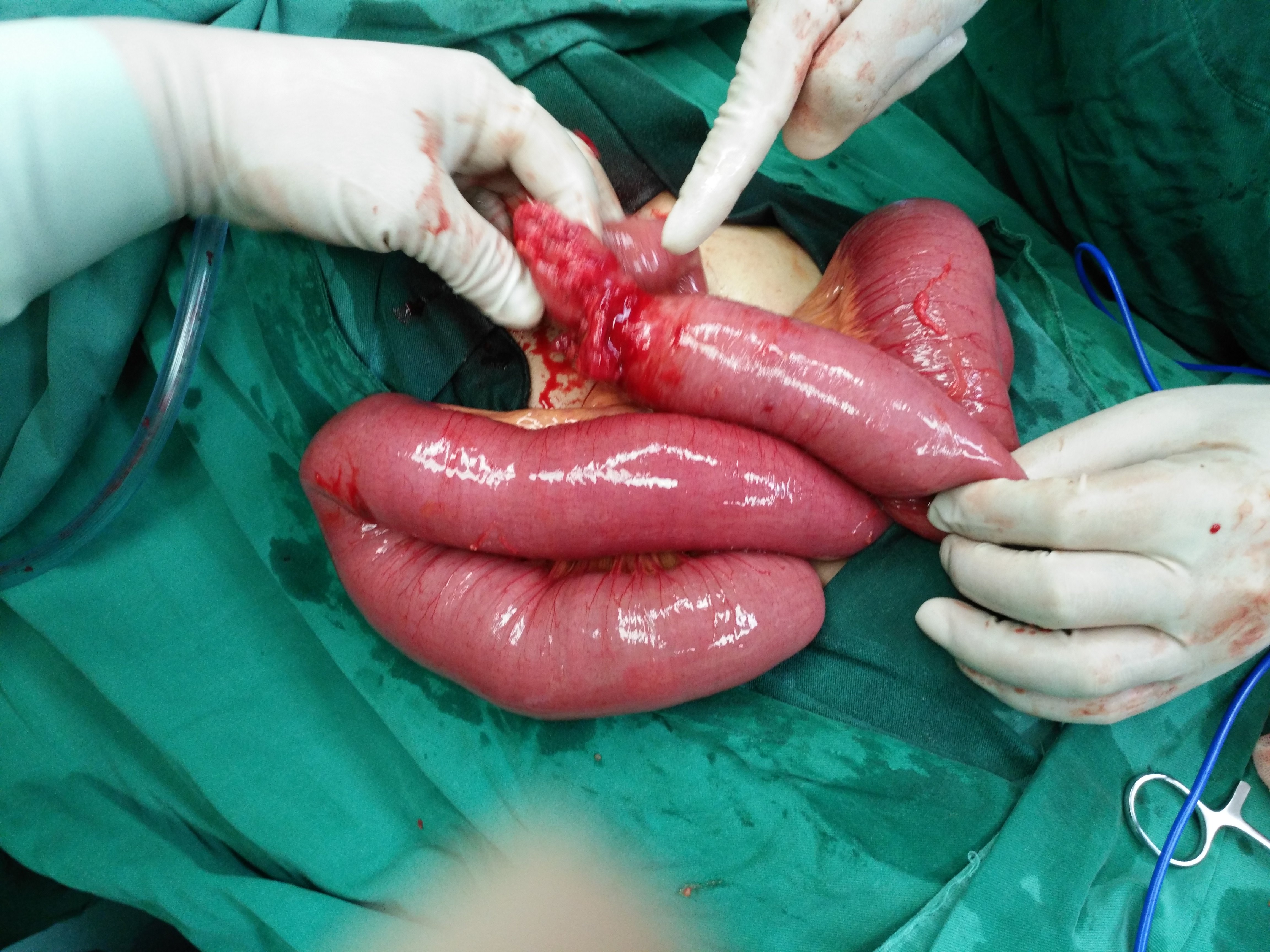 巨型肠梗阻切除术图片图片
