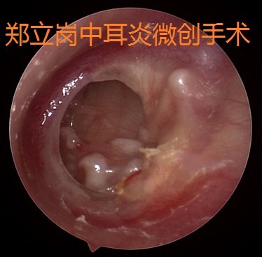 前言:中耳炎微創手術是目前治療慢性化膿性中耳炎及膽脂瘤型中耳炎最