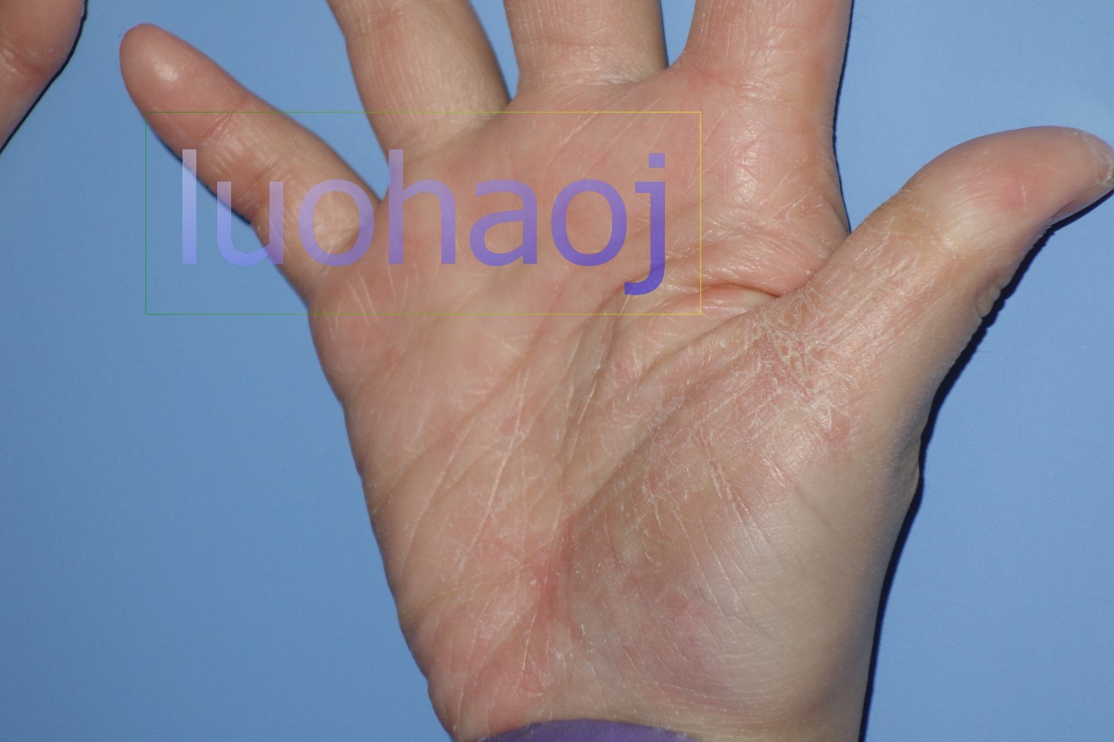 手掌糙皮病早期图片图片