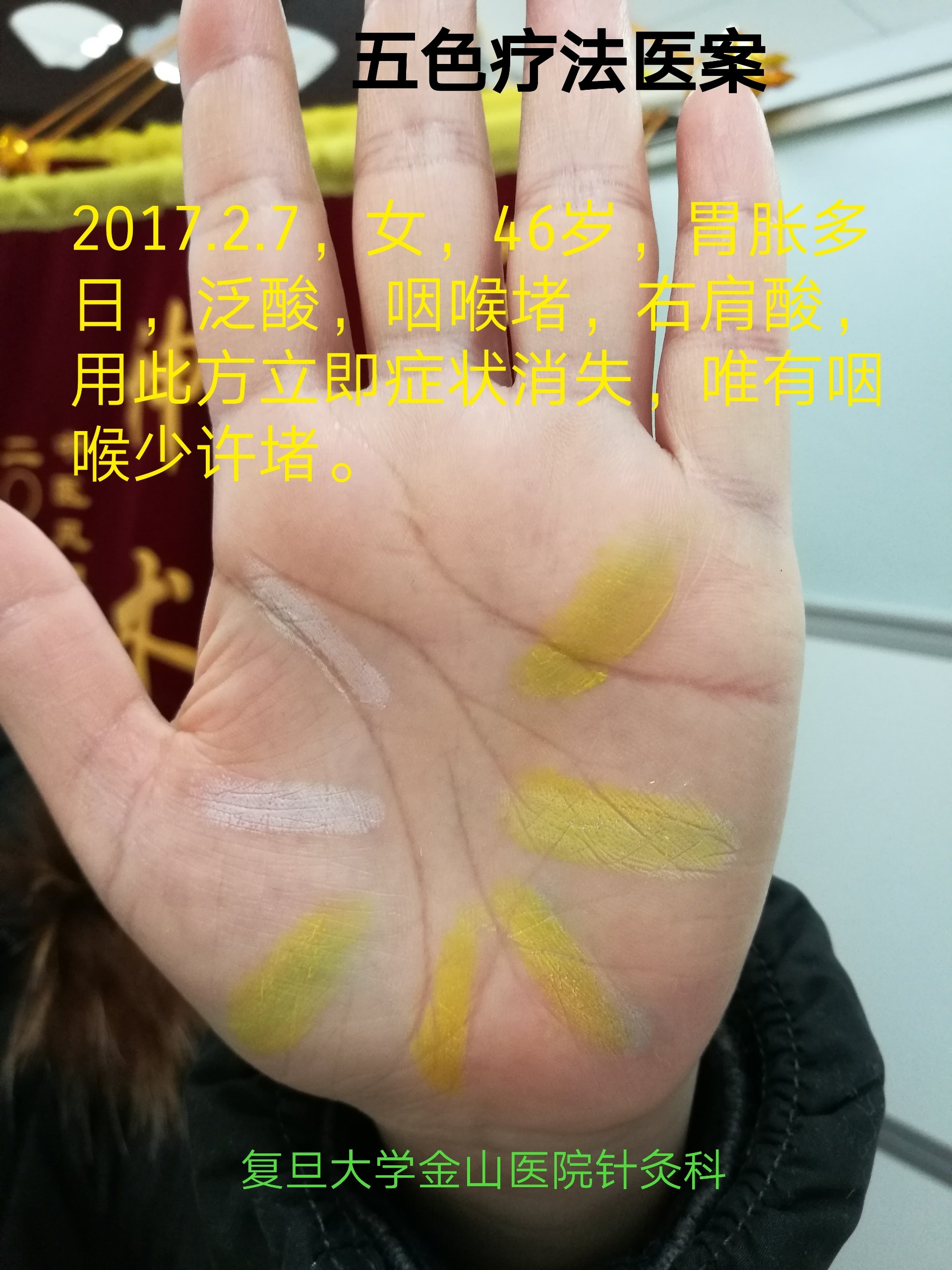 五色疗法治疗胃病效果快