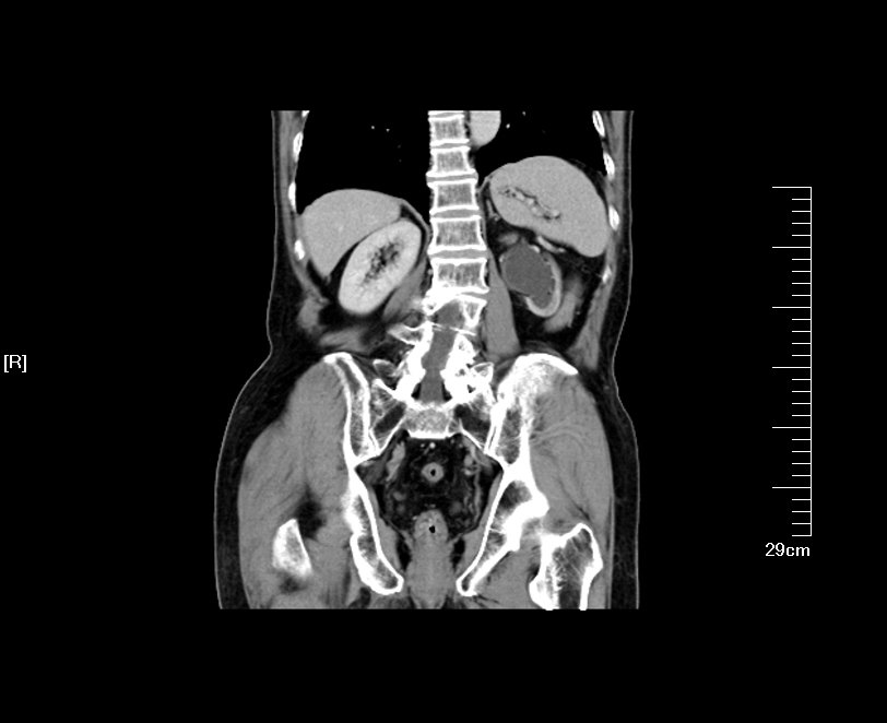 kub ivp:左腎不顯影,ct增強檢查提示:左腎萎縮,左腎積水,左輸尿管中