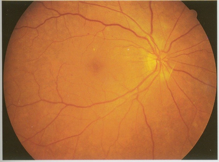 糖尿病视网膜病变筛查治疗最新指南 - 好大夫在线