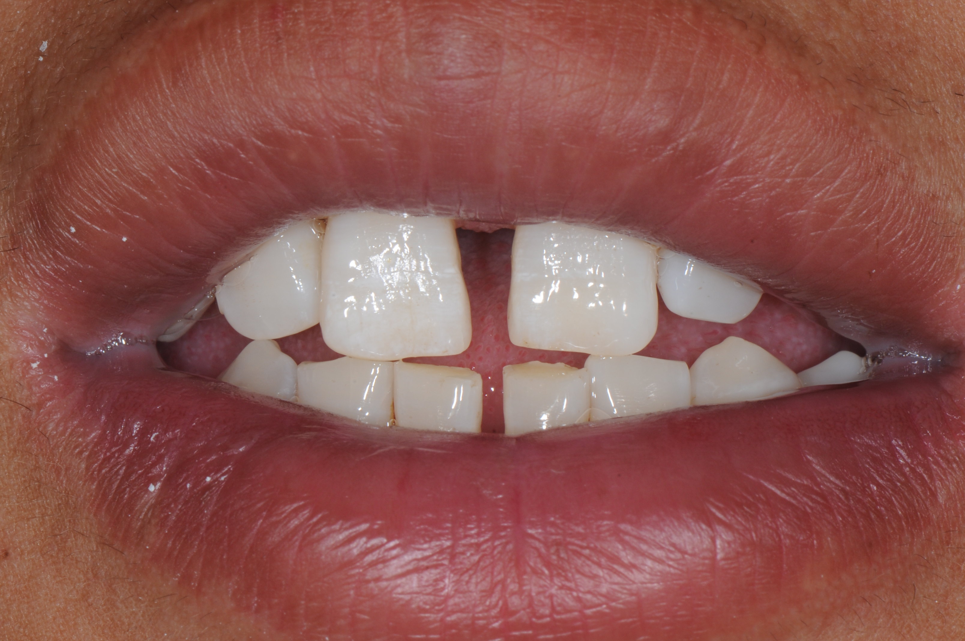 瓷贴面修复前牙散在间隙 - 好大夫在线