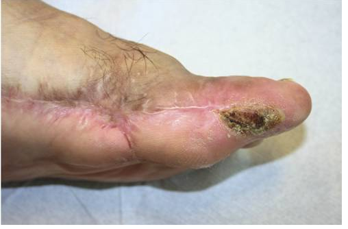 脂肪移植的妙用慢性创面愈合