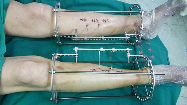 橫向骨搬移手術治療雙下肢老爛腿