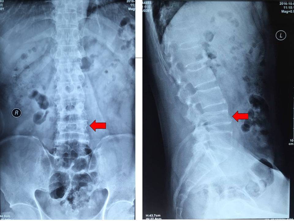 未老先衰的骨骼:强直性脊柱炎系列之骨质疏松篇