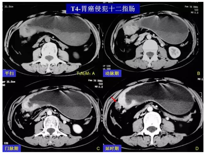 看了這篇 晉級胃癌 ct 診斷高手