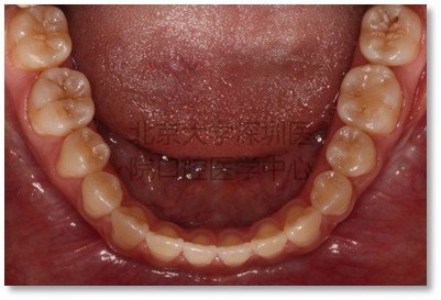 术前下颌牙列                 术后下颌牙列术前头颅侧位片显示下颌