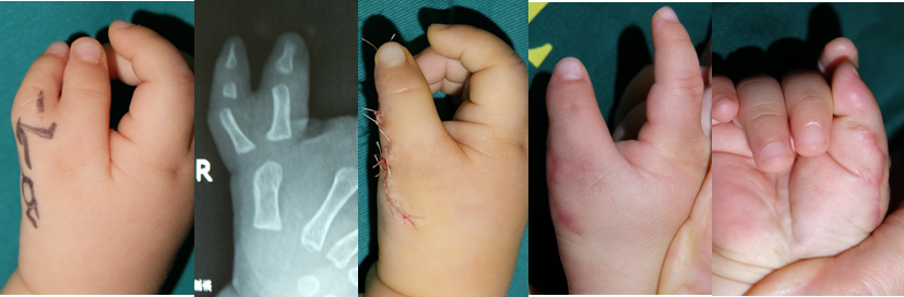 多指畸形概述大量手术实例