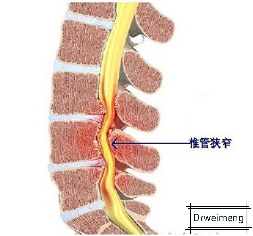 腰椎管狹窄症是由於黃韌帶肥厚增生,小關節增生內聚,椎間盤膨隆突出