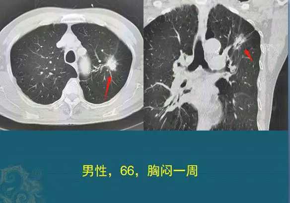 深度解析肺结节良恶性鉴别_肺癌 好大夫在线