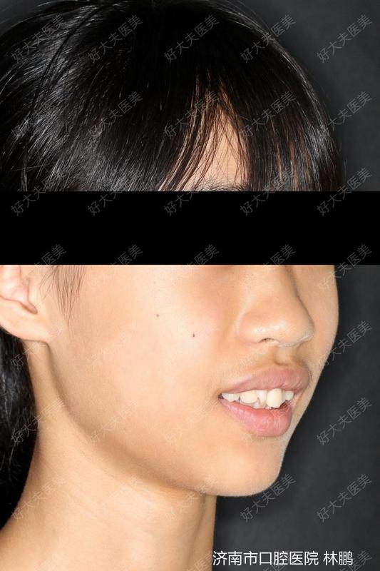 治疗前患者上门牙外翻,下门牙拥挤严重,孩子自述"嘴唇包不住牙齿,不敢