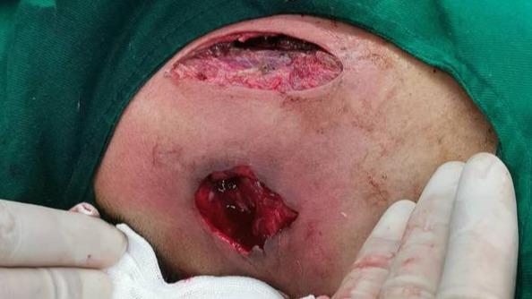 功能性颈淋巴结清扫 结核脓肿病灶清除 vsd引流术治疗脓肿溃疡型颈