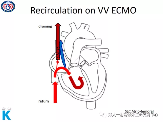 图示ecmo的功能原理 - 好大夫在线