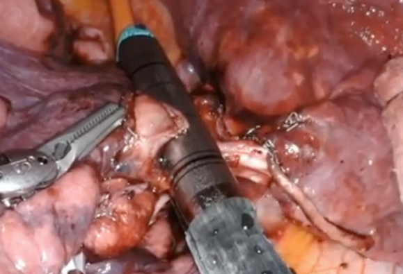 一步一步看懂机器人肺叶切除之-右肺下叶切除 - 好大夫在线