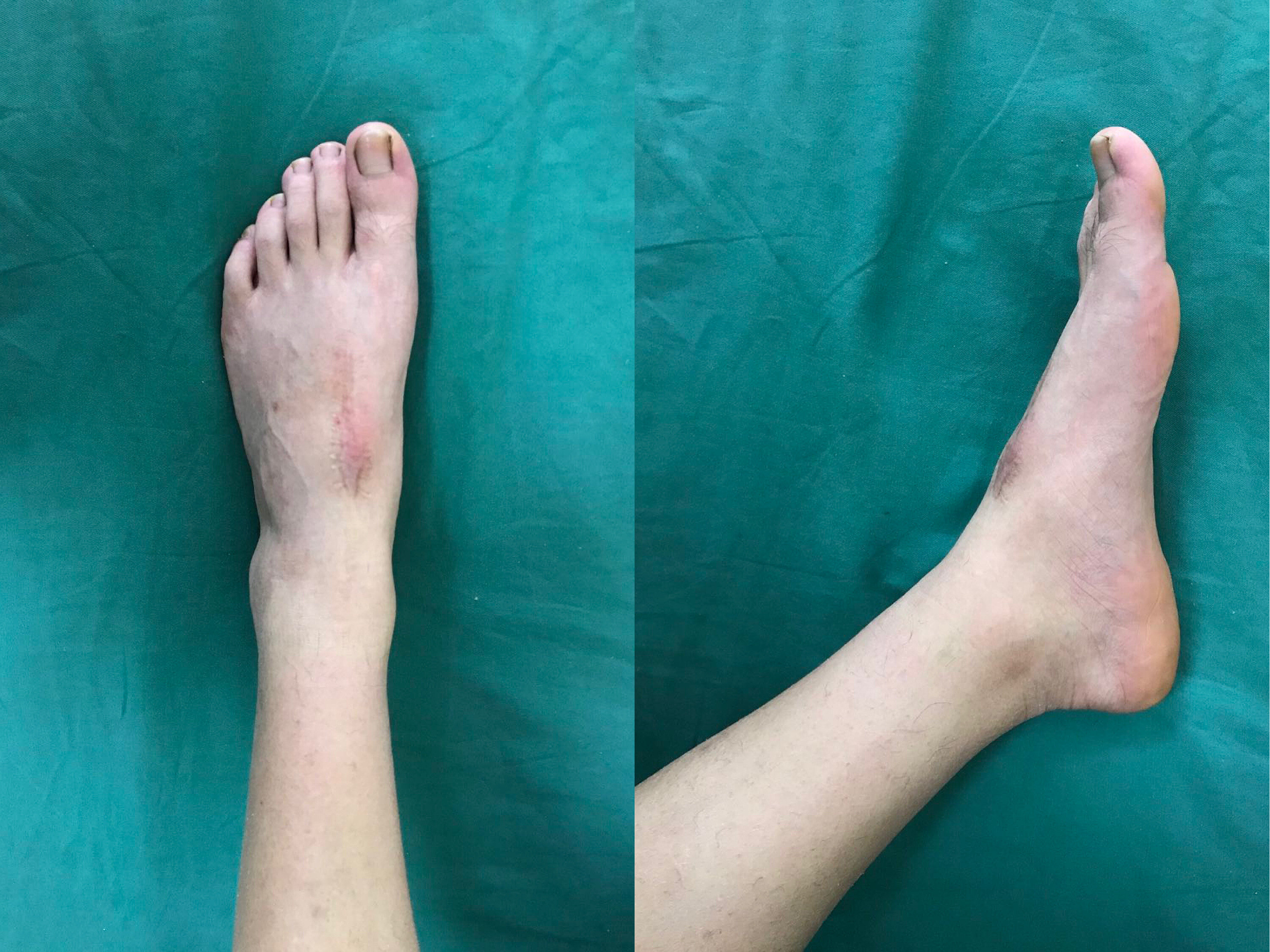 lisfranc损伤处理