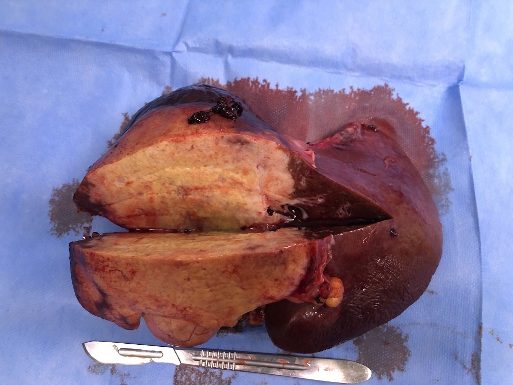 糖类癌胚抗原多少才算癌症_糖类癌胚抗原多少才算癌症_糖类癌胚抗原多少才算癌症