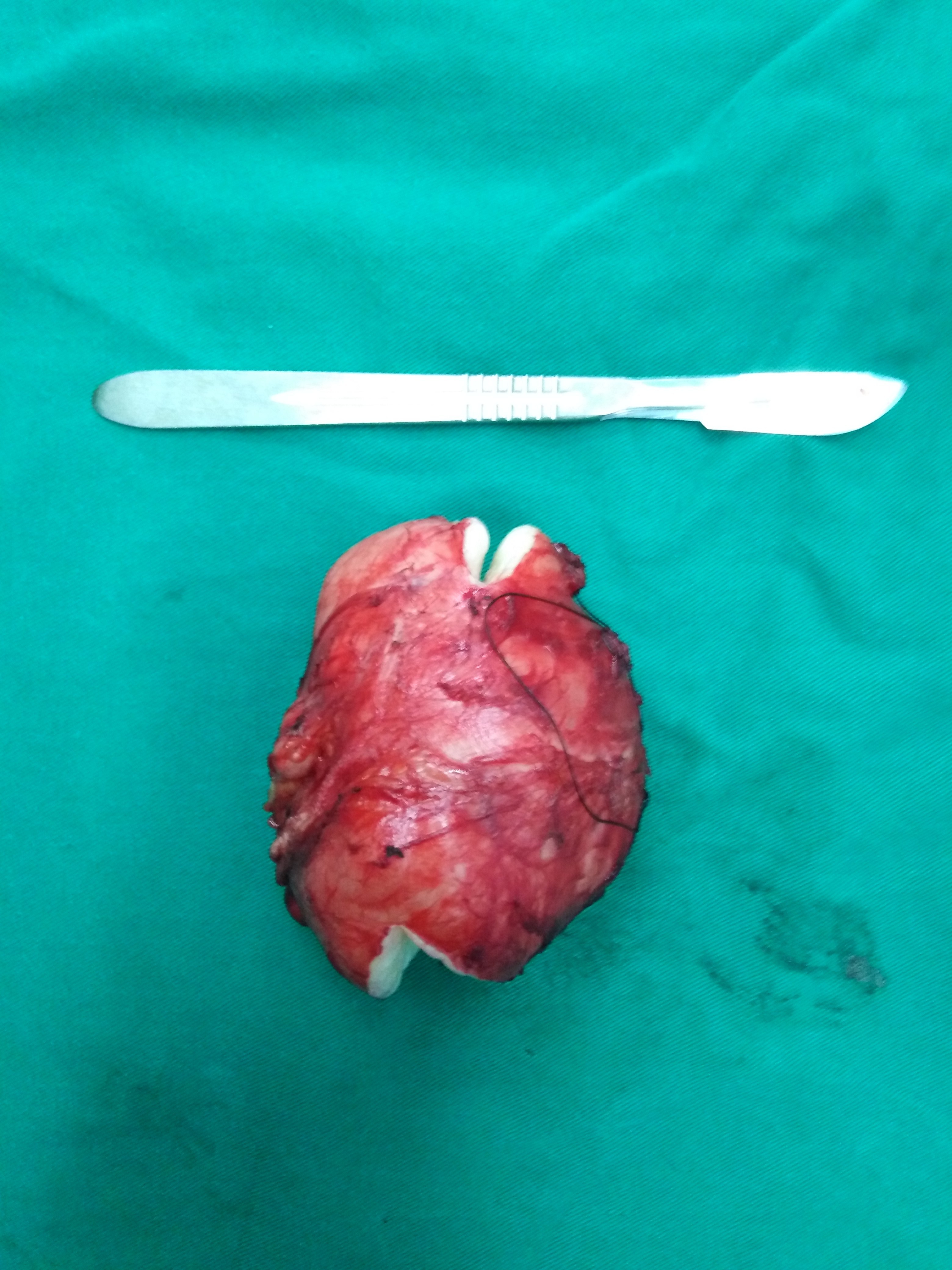 腹部肿瘤图片