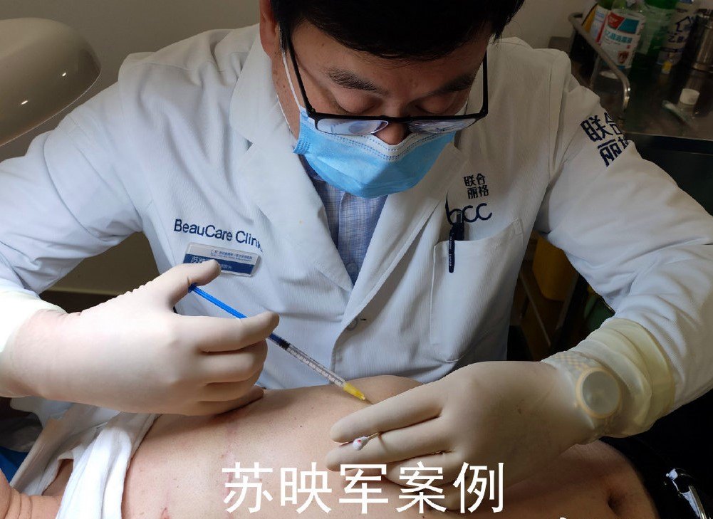 在临床治疗中应用很广泛,疤痕针注射常用的药物是激素,通过改变疤痕