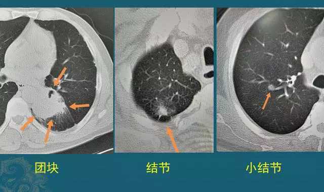 肺部实性结节 良性图片