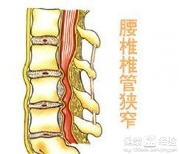 症 狭窄 脊柱 管 腰部脊柱管狭窄症の原因・症状・治療 [骨・筋肉・関節の病気]