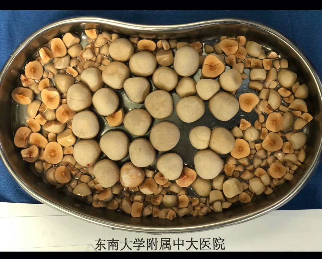 排出肾结石需要多长时间_肾结石怎么能快速排出_排出肾能结石快速排出吗