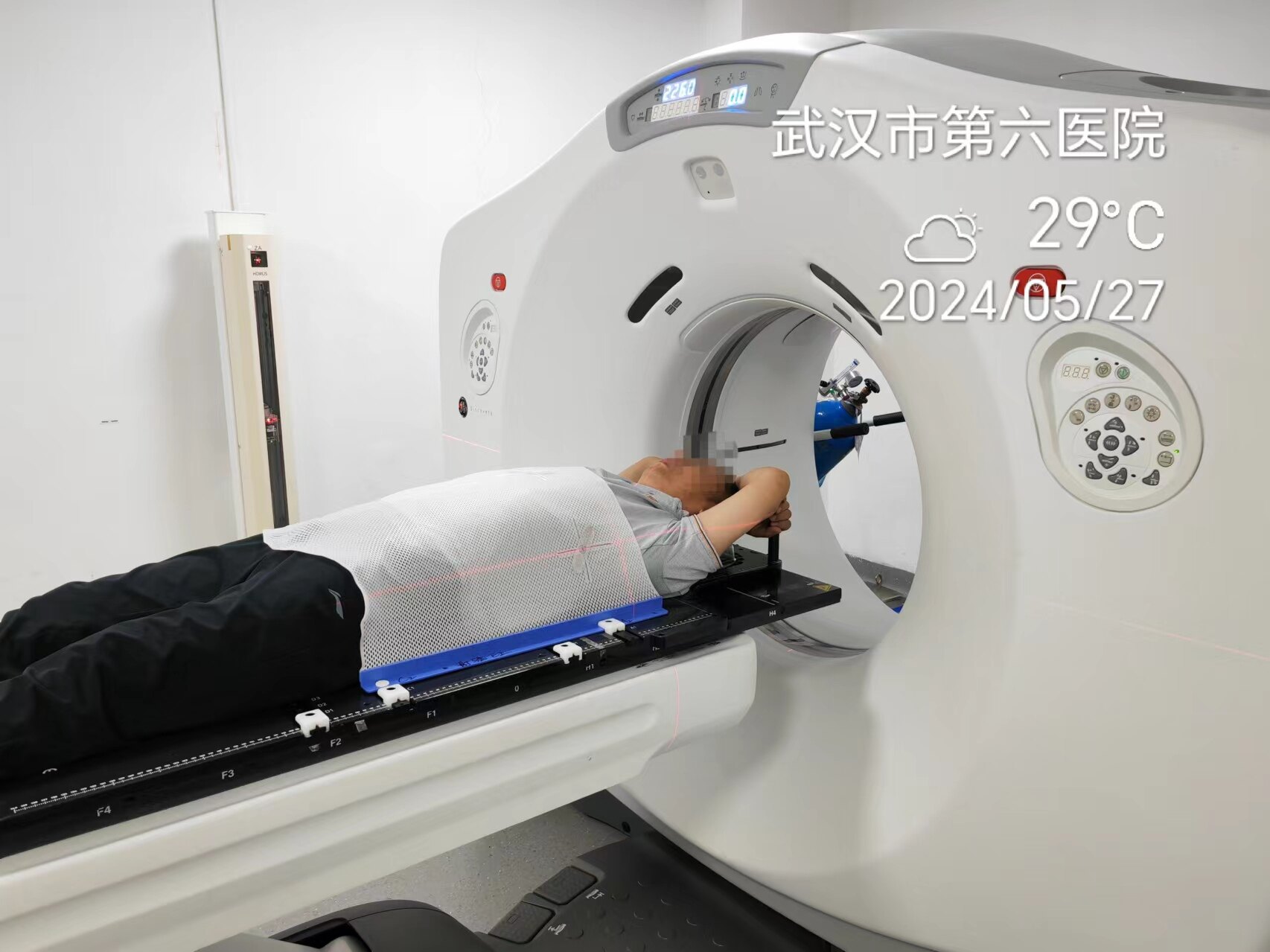 1例（男/56岁）肝内胆管细胞癌以局部治疗为先导的综合治疗-iSABR-5D TOMO放疗_肝内胆管癌_肝内胆管癌治疗方式 - 好大夫在线