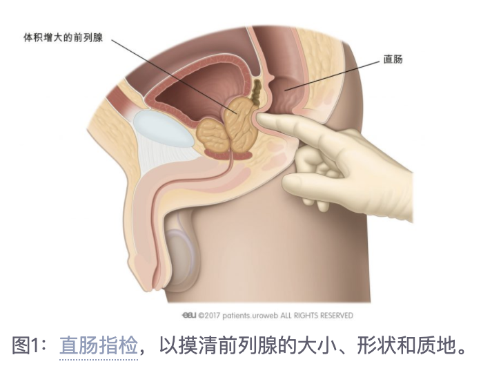 此外,您的医生会用手指进行直肠指检,以摸清前列腺的大小,形状和质地
