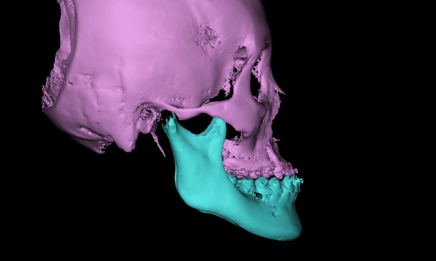 上颌宽度不足,掩饰性正畸后改行正颌手术的骨性iii类病例