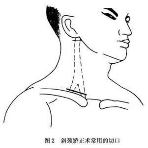 (1)胸锁乳突肌松解术:5岁內可单纯行锁骨头和胸骨头切断松解术,大于